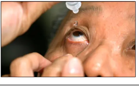 滴眼药水:仰头睁眼、拉下眼睑形成「水池」,把药水滴入